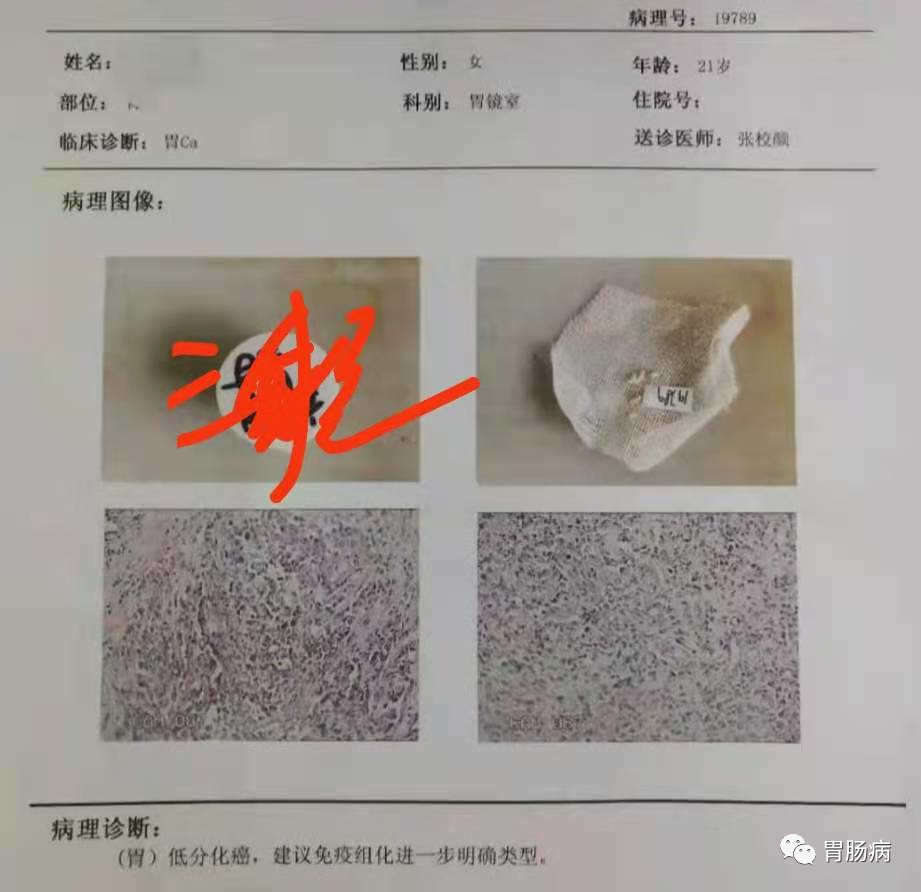 医生总结了3位年轻胃癌患者的病例：30岁不到的他们到底干啥了？